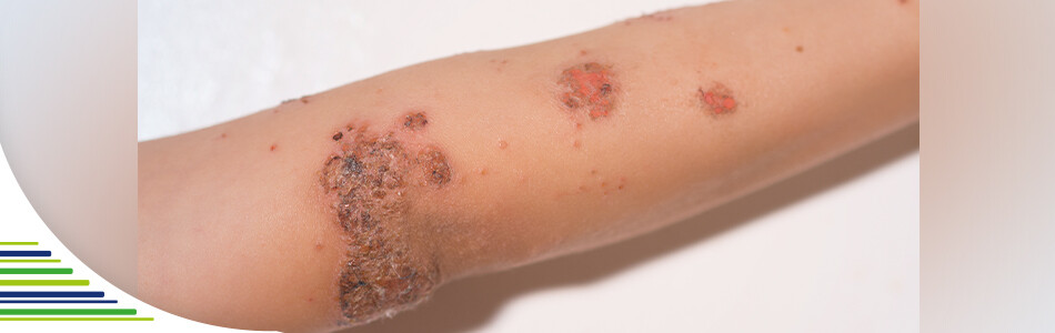 Impetigo – co dělat s nakažlivou bakteriální infekcí kůže?