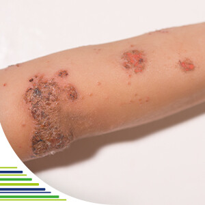 Impetigo – co dělat s nakažlivou bakteriální infekcí kůže?