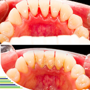 Zubní kámen – příčiny vzniku a prevence