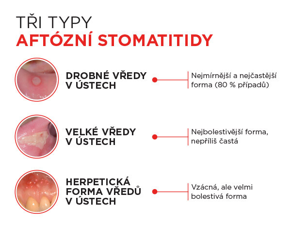 CURASEPT AFTERAPID ochranný gel Aftózní vředy jsou nejčastějšími lézemi na sliznici dutiny ústní a v 80 % případů se první vředy v ústech objevují před 30. rokem věku. benu