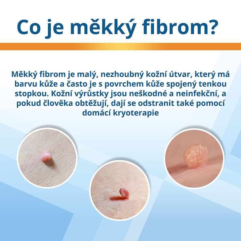 Co je měkký fibrom