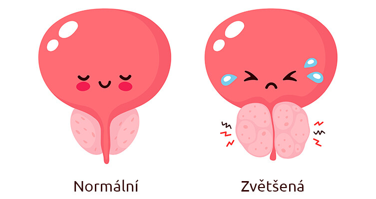 zvětšená prostata